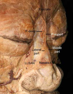 Photograph showing two layers of the procerus. The procerus originated from both superficial and deep layers. The superficial layer of the procerus (P-superf) consisted of a middle part and two lateral parts. The middle part of the P-superf arose from the aponeurosis of the transverse part of the nasalis (Nasalis-t). The lateral parts of the P-superf extended inferolaterally toward the Nasalis-t and the nasal ala. The deep layer of the procerus (P-deep) arose as a few fibers from the nasal bone near the level of the medial palpebral ligament. The P-superf and P-deep merged and then intermingled with the frontalis. The P-superf was elevated slightly to reveal the P-deep. LLSAN levator labii superioris alaeque nasi