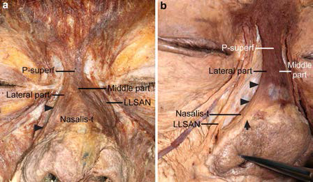 Anatomical relationships of the procerus with the transverse part of the nasalis (Nasalis-t) and the nasal ala. a Some fibers of the lateral part of the superficial layer of the procerus (P-superf) extended and were connected to the Nasalis-t in the anterior aspect (arrowheads). b Some fibers of the lateral part of the P-superf were attached to the skin of the upper portion of the nasal ala (arrow), while other such fibers extended to connect to the Nasalis-t in the anterolateral aspect (arrowheads). The right nasal ala has been pulled slightly medially to show the attachment of the P-superf to the skin of the nasal ala and connection of the extended fibers of the P-superf with the Nasalis-t. LLSAN levator labii superioris alaeque nasi