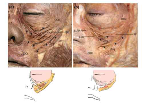 Two shapes of the zygomaticus minor muscle (Zmi, arrowheads). (A) The spread-outtypeoftheZmiwasshapedlikeafan,andusuallyhadmorem uscle fibers that extended from the orbicularis oculi muscle (OOc) than those that arose from the zygomaticbone.(B)ThenarrowtypeoftheZmiwasshapedlikeastrap, andusuallyhadmore muscle fibers that arose from the zygomatic bone than those that extended from the OOc. Abbreviations: LLS, levator labii superioris muscle; LLSAN, levator labii superioris alaeque nasi muscle; OOr, orbicularis oris muscle; Zmj, zygomaticus major muscle. Asterisks indicate the Zmi fibers arising from the zygomatic bone