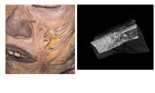 (Left)The LLSAN passed through the upper third of the reference line in all dissected specimens. Thus, the spatial relationship of the facial muscles in the NLF was classified according to the proportion of the LLS in the reference line. As the most common type, When, the LLS passed through the alare to the midpoint of the reference line, the ZMi passed through the total of the middle third of the reference line, and the ZMj passed through the lower third of the reference line in 27.3 %. (Right) In the upper third of the NLF, at the superficial area, the LLSAN, LLS, and ZMi fibers were attached to the dermis of the NLF, interdigitating together in different directions. At the deeper area, the LLS blended with the OOr