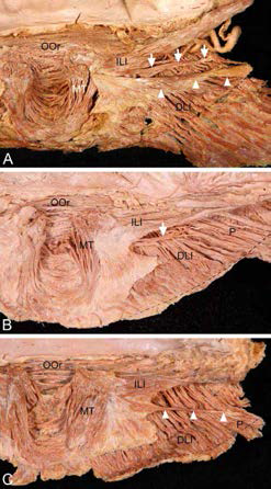 Three patterns of the inferior bundle of the incisivus labii inferioris muscle (ILI) based on the presence the transverse (arrows) and inferolateral slips (arrowheads) in the posterior aspect. (A) The inferior bundle of the ILI had both transverse and inferolateral slips. (B) The inferior bundle of the ILI had only the transverse slip. (C) The inferior bundle of the ILI had only the inferolateral slip. Black dotted lines indicate the inferior margin of the mandible. DLI, depressor labii inferioris muscle; MT, mentalis muscle; OOr, orbicularis oris muscle; P, platysma