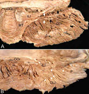 Attachments of the inferior bundle of the incisivus labii inferioris muscle (ILI) to the depressor labii inferioris muscle (DLI) and the platysma (P) in the posterior aspect. (A) The transverse slip (arrows) of the inferior bundle was attached via an aponeurosis to the deep muscle fibers of the DLI and P. (B) The transverse and inferolateral slips (arrowheads) of the inferior bundle were intermingled with the DLI and P. MT, mentalis muscle; OOr, orbicularis oris muscle