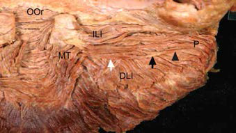 Photograph showing the muscle fibers attached to the aponeurosis of the inferior bundle of the incisivus labii inferioris muscle (ILI) in the posterior aspect. The transverse slip (white arrow) of the inferior bundle became an aponeurosis (black arrow), and some muscle fibers (black arrowhead) arose from the aponeurosis to become part of the muscle fibers of the platysma (P). DLI, depressor labii inferioris muscle; MT, mentalis muscle; OOr, orbicularis oris muscle