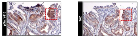 장 재생과정에서 관찰되는 TAZ와 Src의 활성의 상관관계는 종양 형성과정에서도 관찰할 수 있었음