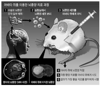 아바타 쥐를 이용한 뇌종양 연구 모델