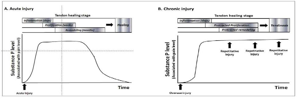 건 손상 시 건 치유 단계에 따른 Substance P level의 변화 (현재까지 연구결과를 종합하여 그린 모식도). 급성 손상 시 염증기(inflammatory phase)부터 점차 증가하기 시작하여 증식기(proliferative phase)에 최고점에 도달한다. 이후 재형성기(remodeling phase)에 접어들며 점차 감소한다. 이러한 Substance P level의 적절한 감소는 치유의 완성에 필요하다. (A) 하지만 만성 손상 시 증가한 SP는 이후 반복된 자극(repetitative injury or mechanical loading)에 의해 지속해서 증가하여 있어，과도한 건 세포 과증식(angiofibroblastic hyperplasia)* 일으킨다. 결국, 치유과정의 완성에 방해되고 건병증을 발생시키게 된다.(B)