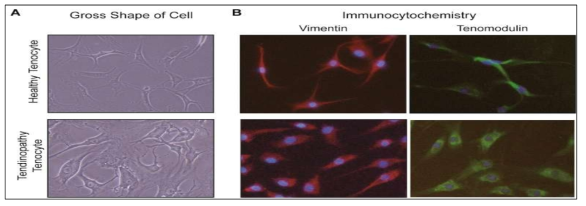 Identification of healthy and tendinopathy tenocytes. Under light microscopy, the morphology of cells from each group was observed (A); The morphology of the tendinopathy group had short elongated processes with more round or oval nuclei compared to the cells from healthy group (A,B); Cells from healthy and tendinopathy tenocyte cultures stained with immunocytochemical methods (B)