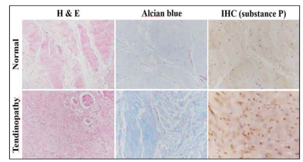 Histological difference between normal and tendinopathic tendon. In the H & E stain and alcian blue stain, tendinopathic tendon had more unorganized collagen fiber with the hypercellularity.In the immunohistochemisty of substance P, as expected, the stain intensity was higher in the tendinopathic tendon compared to normal