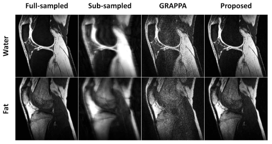 가속비 6일 때 제안하는 기법과 기존복원기법 (GRAPPA)를 이용하여 분리한 물/지방 영상
