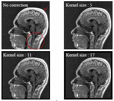 여러 kernel size로 보정한 영상. (화살표와 원은 blurring artifact 영역을 표시한다.)