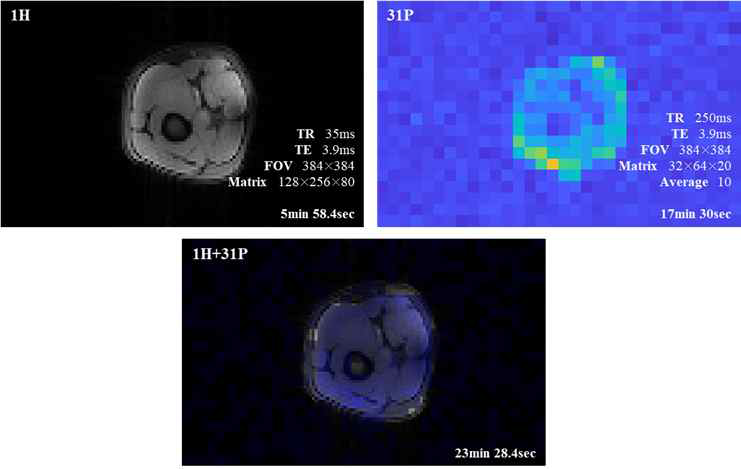 7T MRI에서 획득한 proton 및 31P 다리 영상