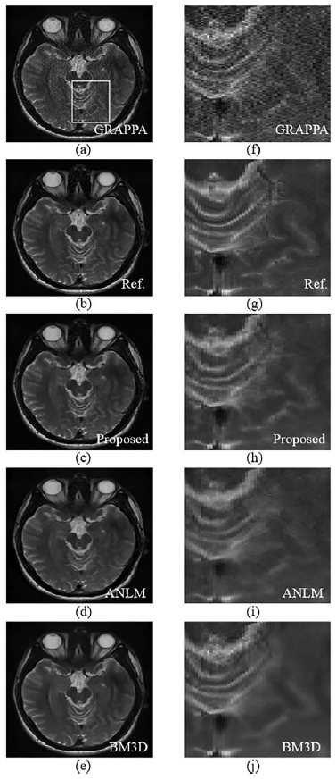 T2w 복원 영상 (a) GRAPPA, (b) Reference, (c) 제안하는 방법, (d) ANLM[3], (e) BM3D[4]. (f-g) 흰색 윈도우에서의 각 복원영상의 확대 영상