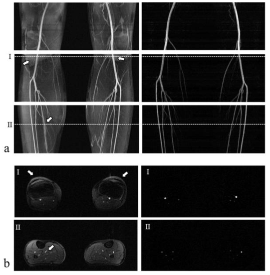 제안하는 방법의 in-vivo 하반신 혈관 영상