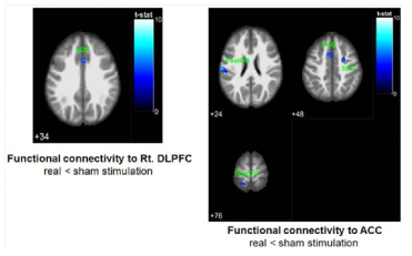 real tDCS군과 sham tDCS군 간의 기능적 뇌연결성 변화 비교