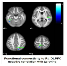 real tDCS군에서 Rt. DLPFC영역의 기능적 뇌연결성 변화와 갈망 변화간 상관관계