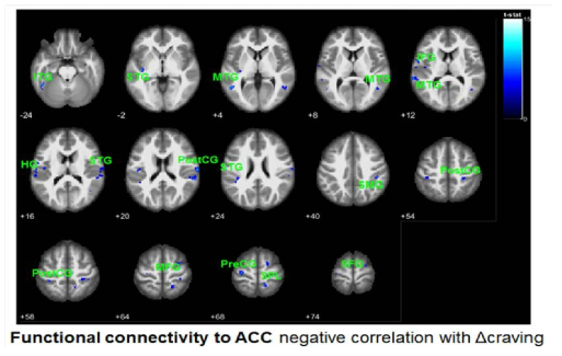real tDCS군에서 ACC영역의 기능적 뇌연결성 변화와 갈망 변화 간 상관관계