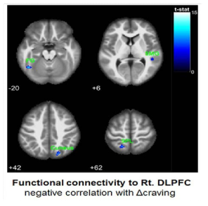 real tDCS군에서 Rt. DLPFC영역의 기능적 뇌연결성 변화와 갈망 변화간 상관관계