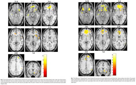 약물 중독 환자의 뇌 활성화(오른쪽)과 인터넷 게임 중독 환자의 뇌 활성화 (Ko et al., 2009)