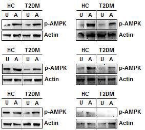제2형 당뇨병 환자와 건강인 말초혈액 단핵세포에서 AMPK 활성도 측정