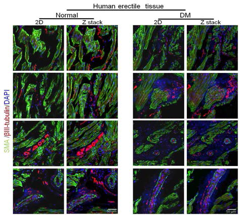 Decrease in the expression of a neuronal marker in the penis of a diabetic patient with erectile dysfunction