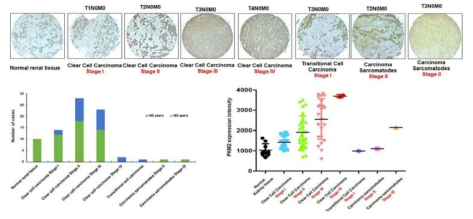 신장암 환자의 정상조직과 암조직에서 pyruvate kinase M2의 발현 패턴 비교