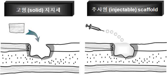 고형 스캐폴드(좌측)와 주사형 하이드로젤(우측)의 비교