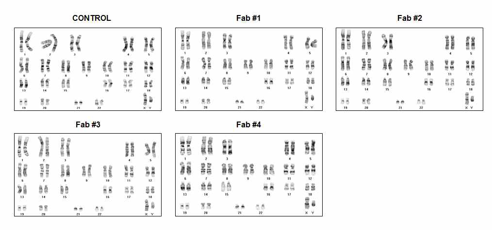 신규 파브리병 환자 유래 역분화 줄기세포들의 정상 핵형 확인