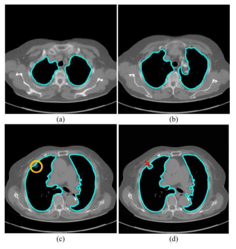 CV 모델을 사용한 폐 윤곽선 검출의 결과. (a),(b)는 정확한 윤곽선을 검출하지만, (c),(d)의 경우 잘못된 Segmentation 으로 인한 잘못된 윤곽선 검출