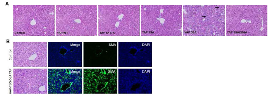 (A) 정상 또는 돌연변이 YAP을 간세포 특이적으로 과발현 할 수 있는 바이러스 주입후 간 조직 사진 (B) AAV-5SA YAP 주입한 마우스 간에 대한 H&E 및 근섬유아세포 (SMA) 형광염색 결과