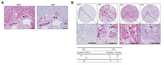(A) 사람 정상 간 조직 및 (B) 간담관암 조직에서의 NF2, YAP 항체 면역염색결과