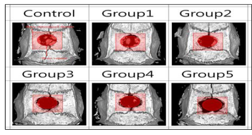 The Radiographic images and score graph of bone induced osteomyelitis. Micro CT images of osteomyelitis calvaria bone with defect. 대조군과 G1의 평균 골량은 다른 군의 평균 골량보다 높았으며. 감염균주의 투여 용량이 증가함에 따라 골 무기질 밀도는 감소하는 것을 확인하였다. G3 그룹에서는 대조군에 비하여 뼈의 부피 및 무기질의 밀도가 낮은 것으로 모아 골수염 감염이 유도된 것으로 판단된다
