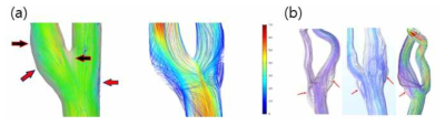 (a) 실험적 및 해석적 혈유동 가시화 기술 비교, (b) CFD를 이용한 환자별 Flow pattern에 따른 질병 예측 기술