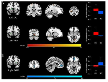 정상 대조군과 비교하여 초기 정신증에서 차이가 나는(증가된 또는 감소된) 휴지기 선조체 뇌 연결성