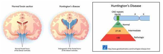 헌팅턴 병에서 lateral ventricle의 frontal horn 확장이 관찰됨 (왼쪽). 헌팅턴 병에서 비정상적으로 증폭되는 CAG repeat가 35는 병적 증가 상태이며, 증폭수가 많을수록 청소년기(55이상)에도 발병 가능성이 있음 (오른쪽)