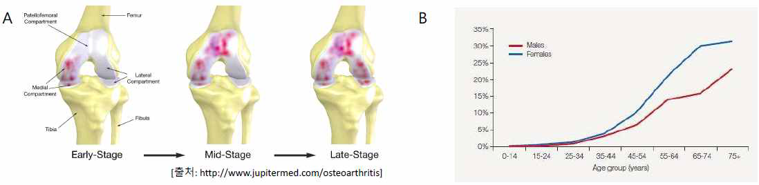 (A) 퇴행성관절염에 걸린 무릎 모식도 및 진행 단계. (B) 나이별 퇴행성관절염 발생율 통계 (출처:http://www.medicographia.com/2013/10/epidemiology-of-osteoarthritis/)
