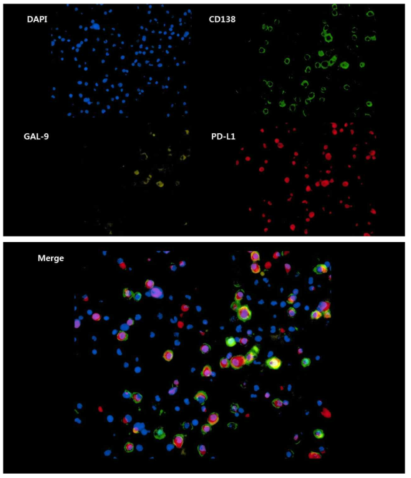 자동형광현미경을 이용하여 다발골수종 환자의 골수 내 형질세포(CD138)에서 PD-L1과 Gal-9의 발현을 확인함. (original magnification ×400)