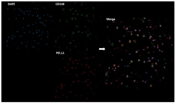 공초점현미경을 이용하여 다발골수종 환자의 골수 내 형질세포(CD138)에서 PD-L1의 발현을 확인함. (original magnification ×200)
