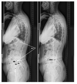 엑스레이를 이용한 척추의 시상면 균형의 평가