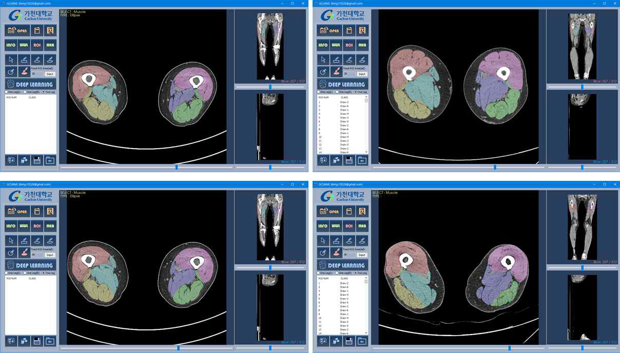 완성된 딥러닝 기반 대퇴부 근육 자동 분할 소프트웨어