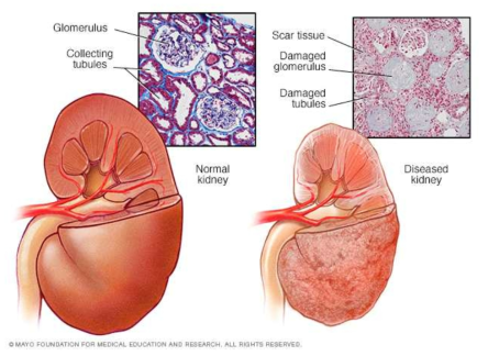 정상 신장과 질환 신장. Mayo foundation for medical education and research