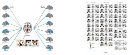 자폐 환자에서 시상-대뇌피질의 기능적 연결 구조가 다양한 대뇌피질 부위에서 저하되어 있음 (adapted from Autism Research, 2016)