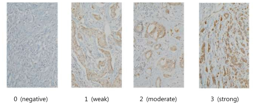 양성 및 유방암 조직 10 례에서 MFG-E8 단백질 발현 면역 화학염색