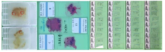 (좌) 유방암 조직의 파라핀 블록, (중) 유방암 조직의 슬라이드, (우) 확보된 TMA 유방암 조직과 슬라이드에서 암세포가 가장 많이 분포된 위치에 동그라미로 표시가 되어 있음