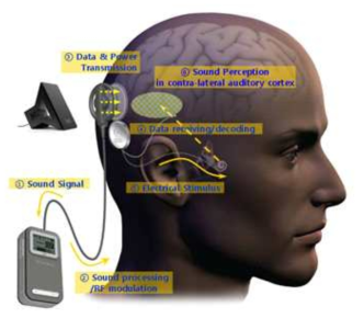 인공와우 장치의 원리. ①소리 신호 입력 ②신호 분석 및 자극 신호를 디지털로 변환 ③변환된 신호와 전원을 무선으로 전송 ④디지털 신호를 전기 자극 신호로 변환 ⑤채널별로 신경을 전기 자극 ⑥전기 자극을 뇌에서 소리로 인식