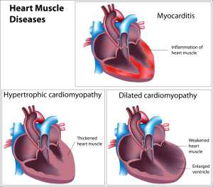 심장 근육 질병 종류 및 증상