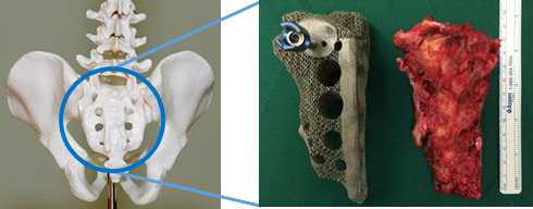 골반뼈(천추)의 티타늄 3D 프린팅. (좌) 골반뼈 (천추) (우) 복원된 티타늄 재질의 골반 뼈 보형물과 악성종양으로 감염된 골반뼈의 일부