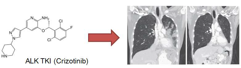 Crizotinib 투여 후 ALK fusion 폐암 환자에서 보이는 급격한 종양 감소