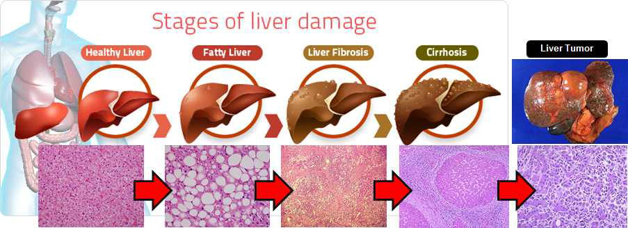 간질환의 진행과정