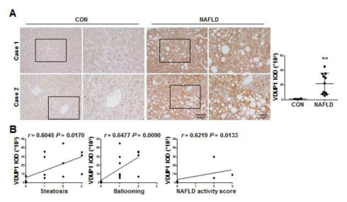 NAFLD 환자에서 VDUP1의 발현 및 steatosis, hepatocellular ballooning, lobular inflammation (r = 0.5160, P = 0.0492) 및 NAFLD activity score와의 상관성 분석