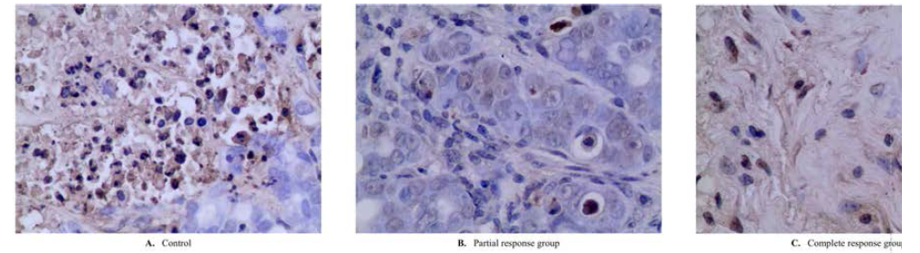 Proliferation index : dark-brown cells are anti-human Ki 67 rabbit monoclonal antibody positive cells (A & B) and 5-FU loaded micelle decreased cell proliferation significantly(C)(×400)